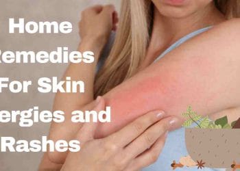 Home Remedies For Skin Allergies and Rashes