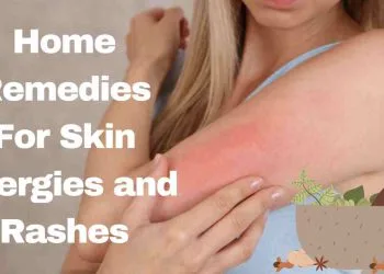 Home Remedies For Skin Allergies and Rashes