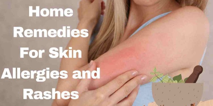 Home Remedies For Skin Allergies and Rashes