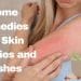 Home Remedies For Skin Allergies and Rashes