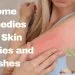 Home Remedies For Skin Allergies and Rashes