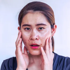 What are the skin damages caused by sunlight?