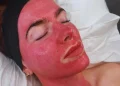 After Microneedling women face