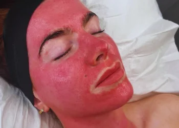 After Microneedling women face